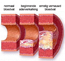 Verschil tussen een normaal bloedvat, beginnende aderverkalking en een ernstig vernauwd bloedvat