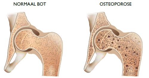foto voor en na Osteoporose